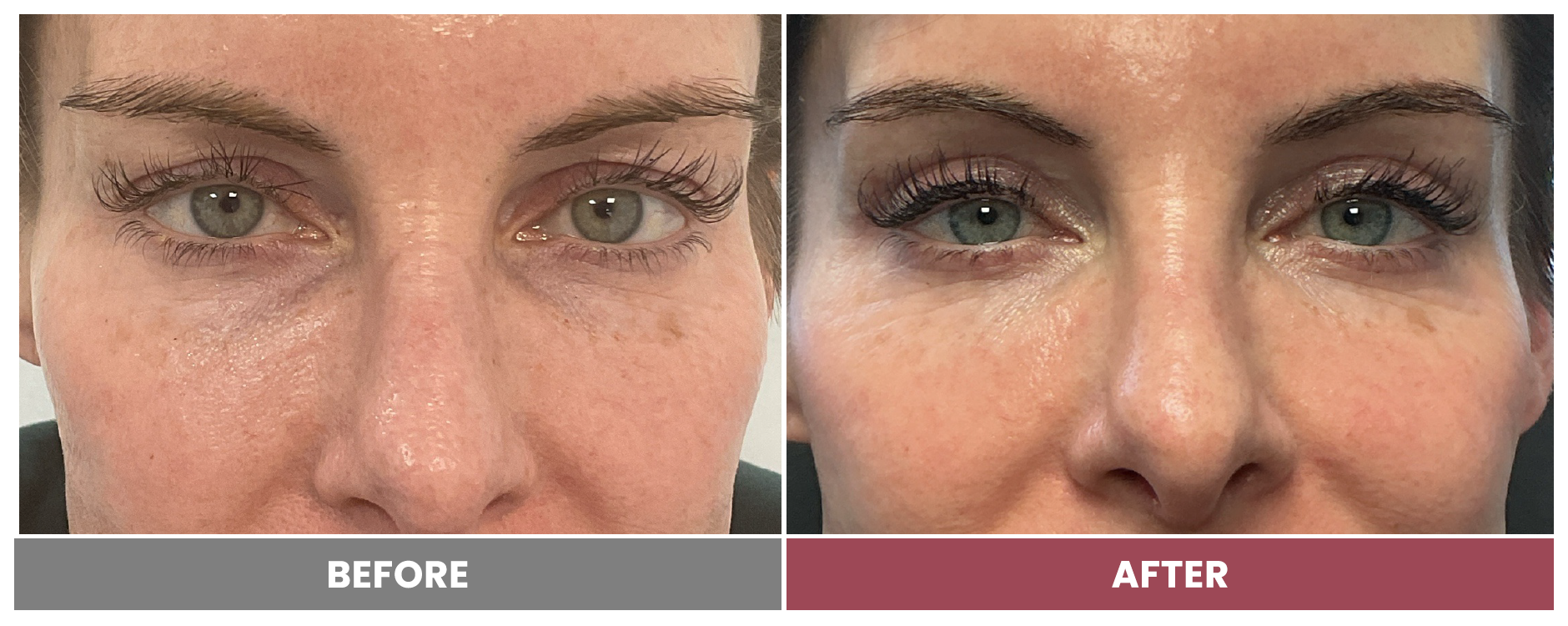 Upper Blepharoplasty - Case erica-pettigrew